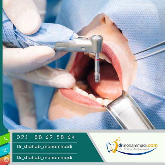 معایب کاشت ایمپلنت و عوارض جانبی ایمپلنت دندان